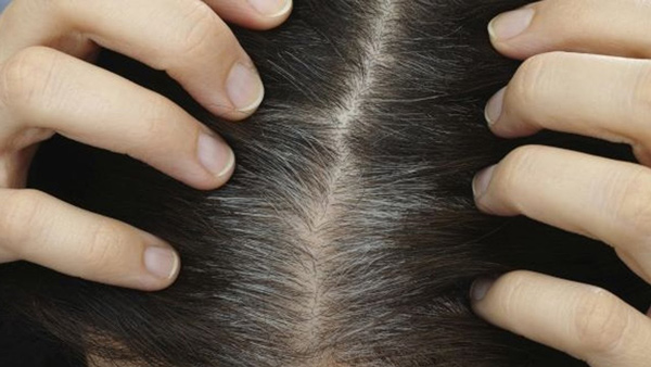 Nguyên nhân dẫn đến bệnh bạc tóc sớm?