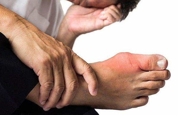 Đâu là triệu chứng bệnh gout?