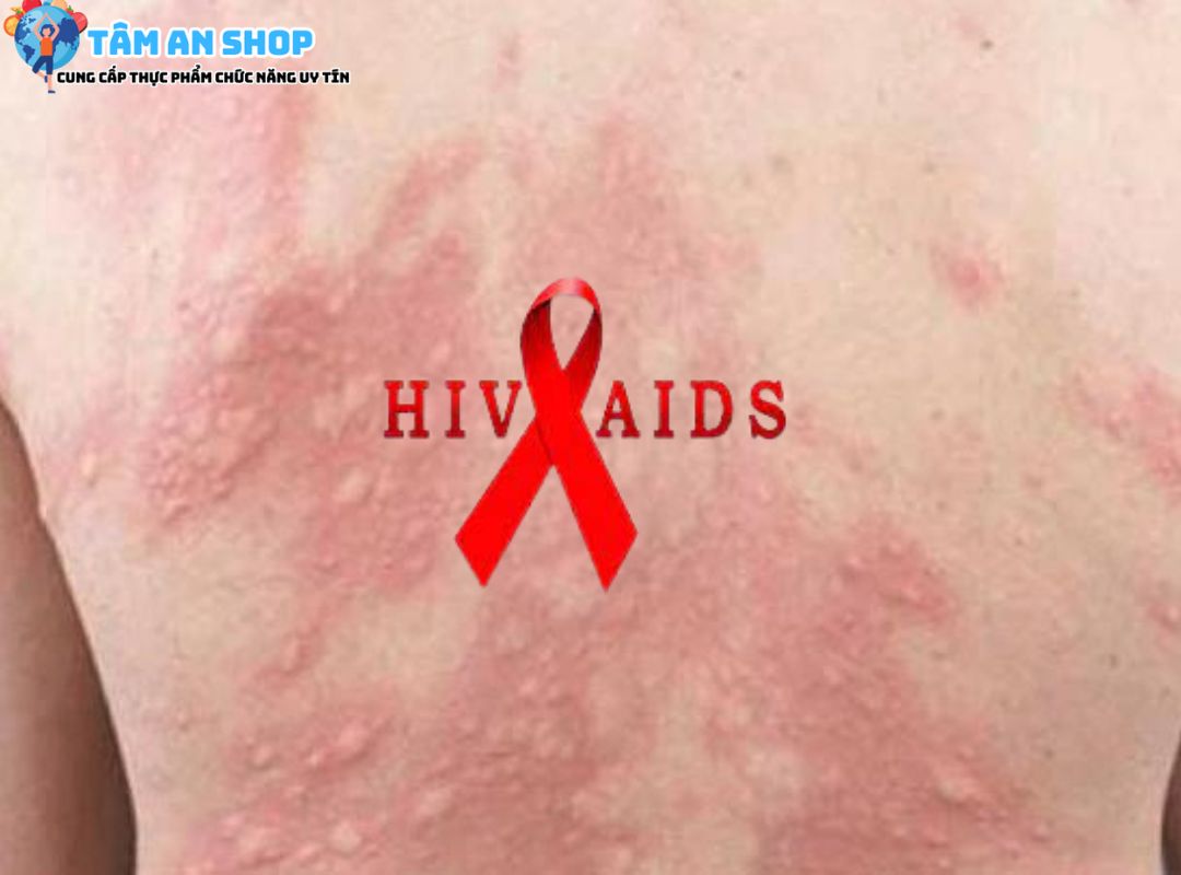 Dấu hiệu mắc HIV